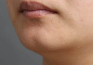 エイジング治療のお悩み 割れ顎に関するブログ一覧 Dr 志田